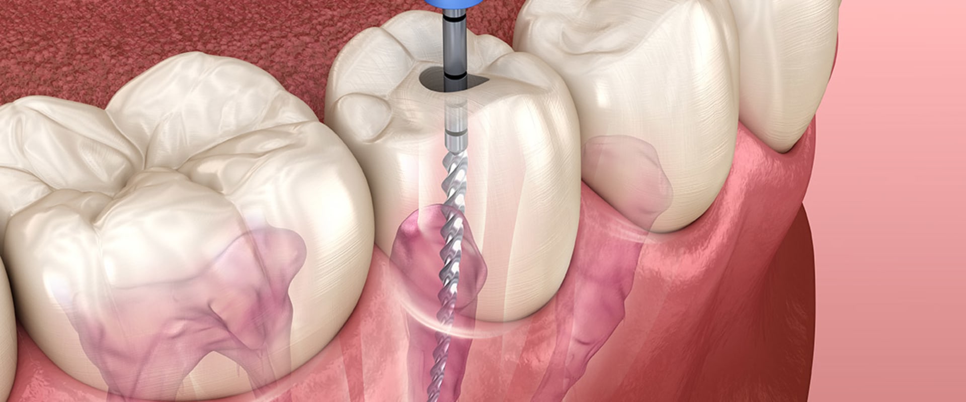 Root Canal Retreatment A Comprehensive Guide
