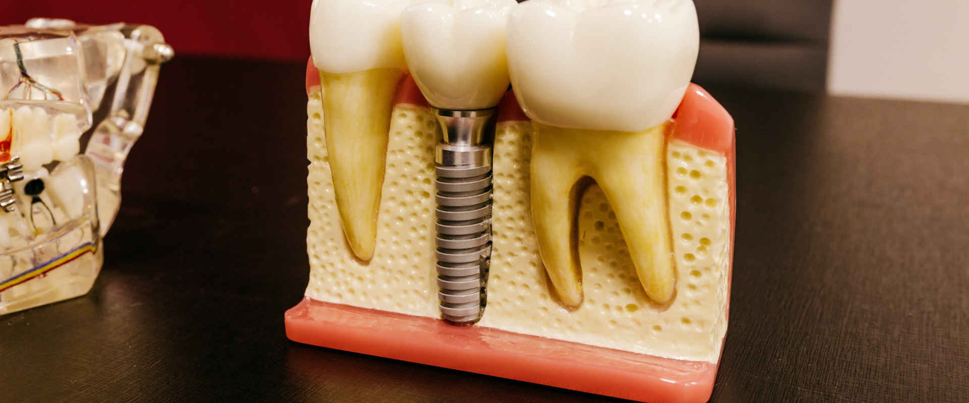 Dental Revolution The Harmony Of Dental Implants And