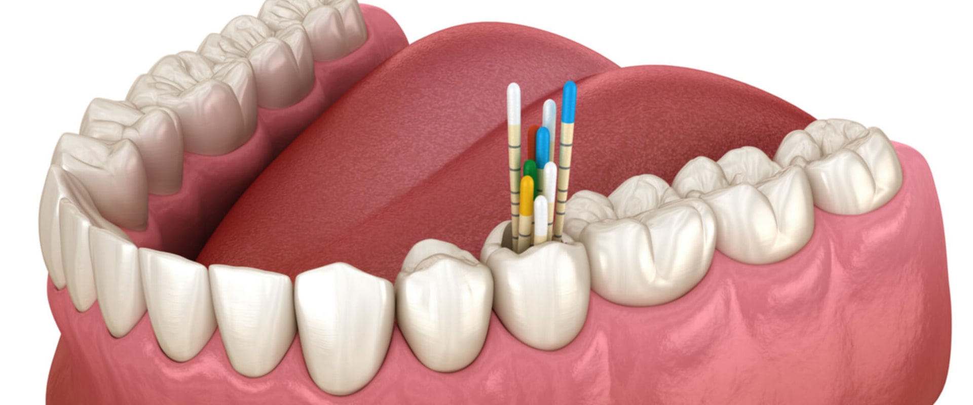 What are Endodontic Files Made Of? A Comprehensive Guide