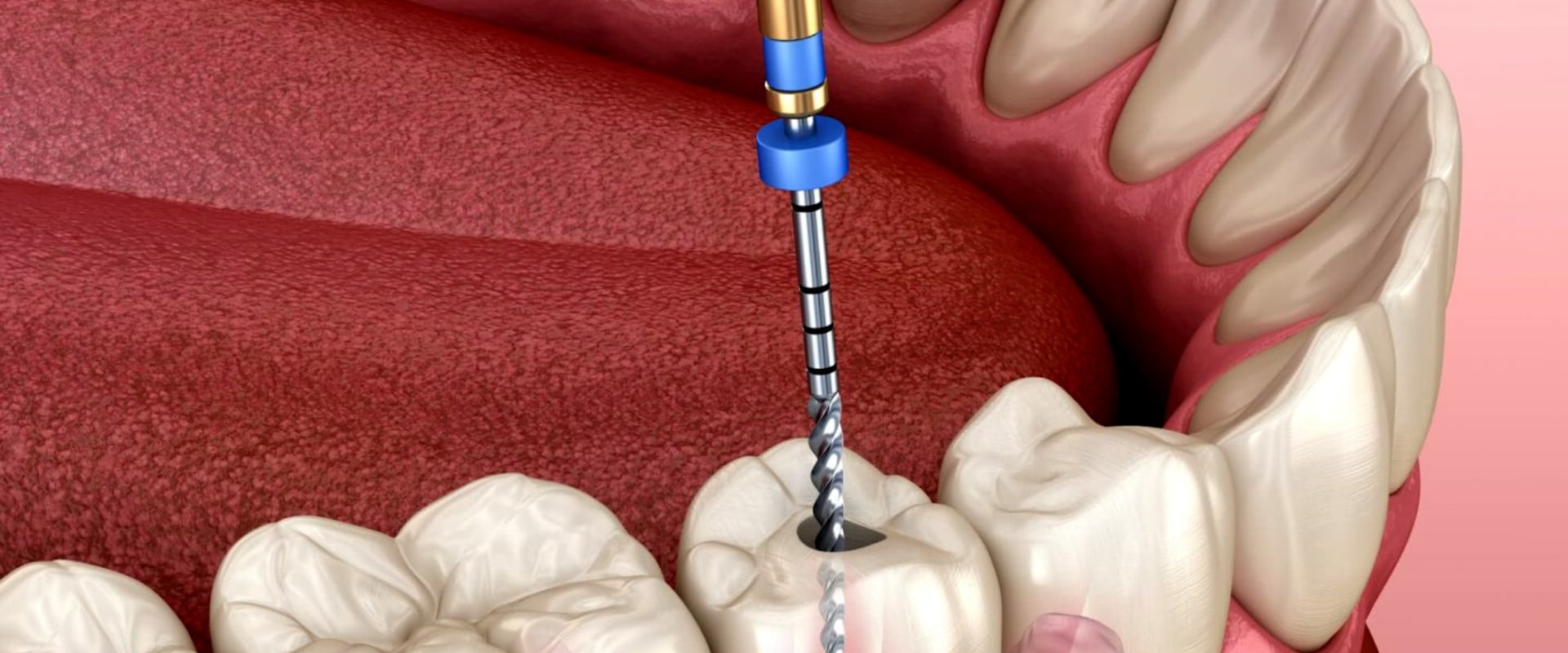Ensuring a Successful Endodontic Treatment