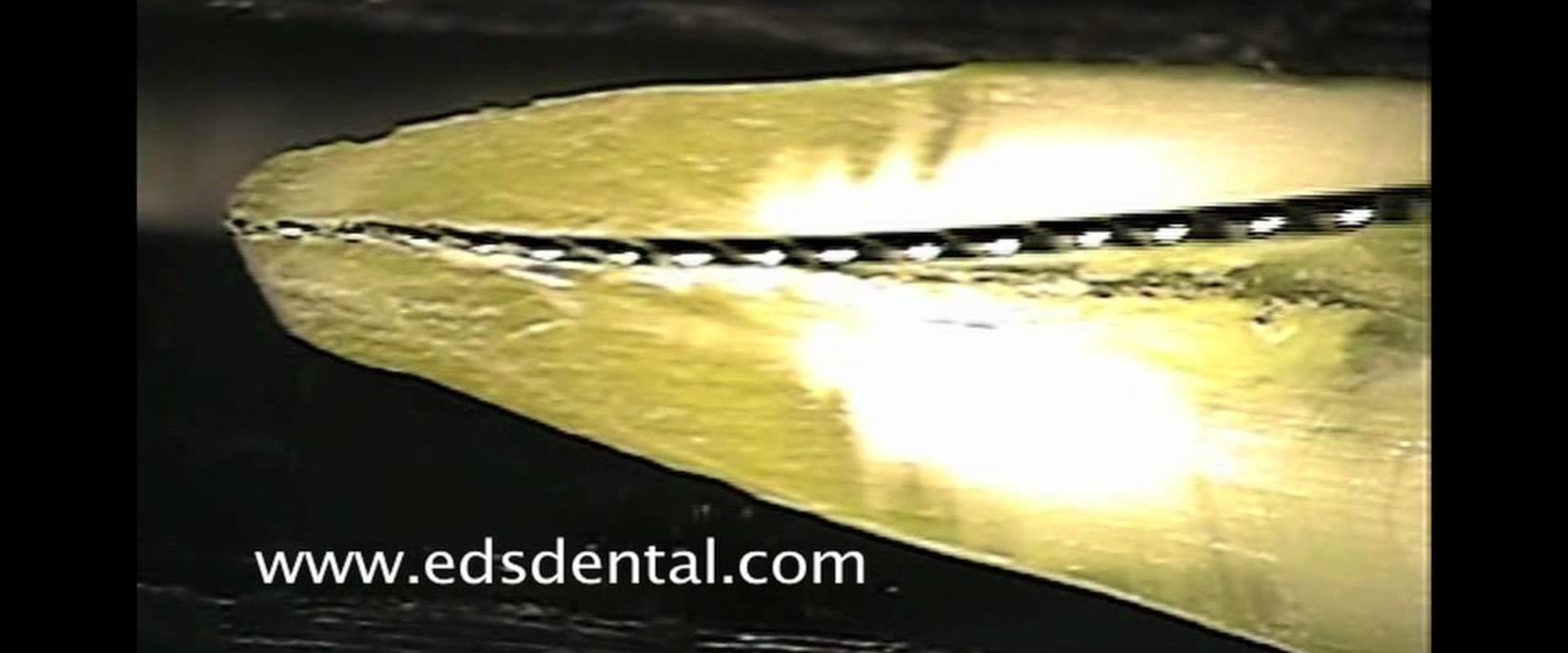 What is an Endodontic Reamer and How Does it Work?