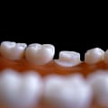 How Endodontics and Orthodontics Unite for Oral Health